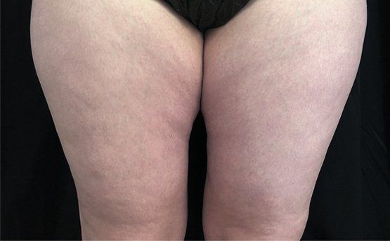 Thick thighs with visible cellulite. Light skin, dark background.