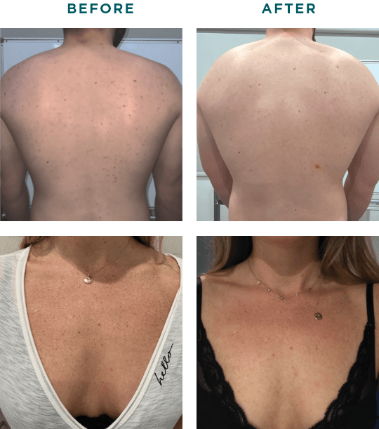 VI Peel Body Before and After