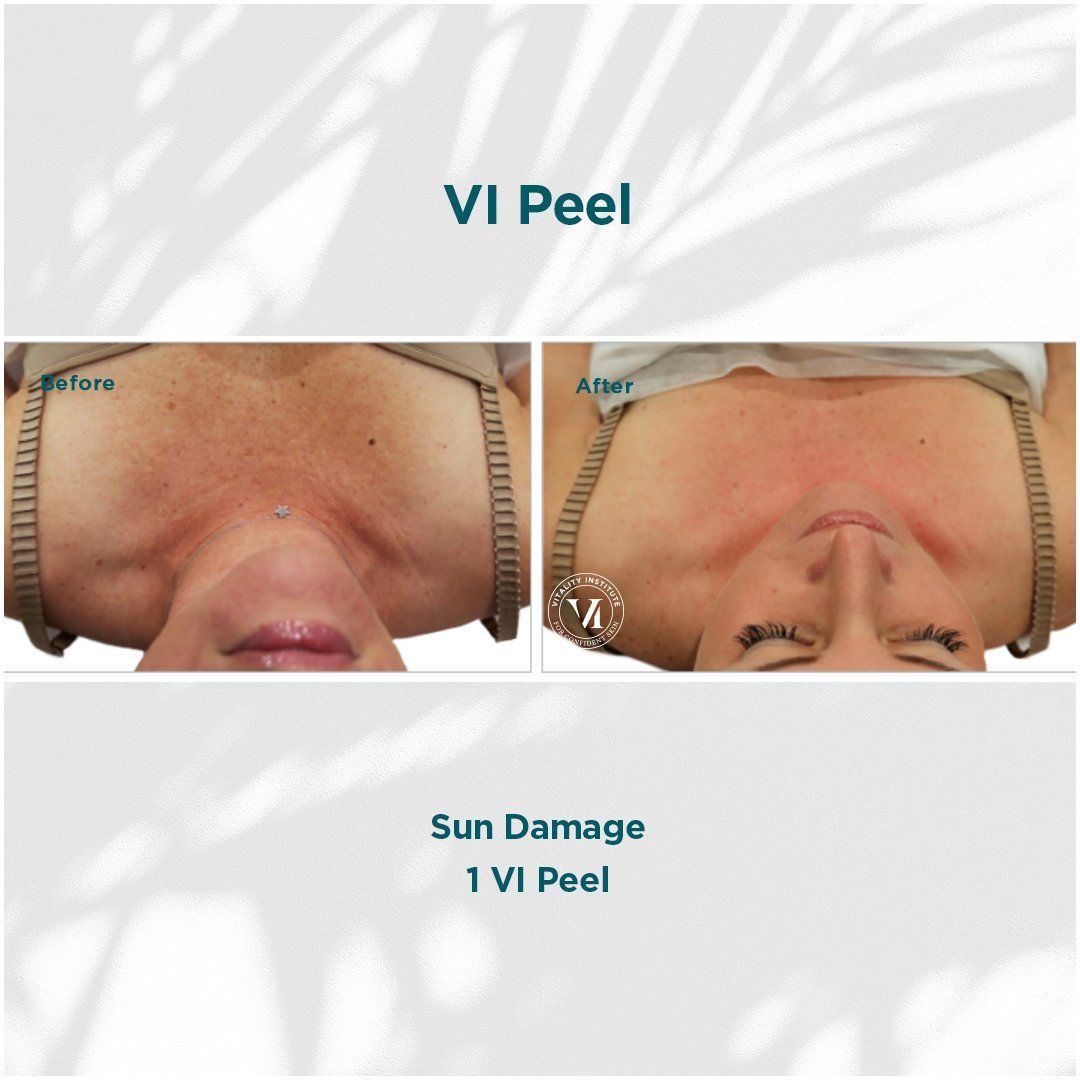 Before and after of a woman's chest after a VI Peel, showing reduced sun damage.