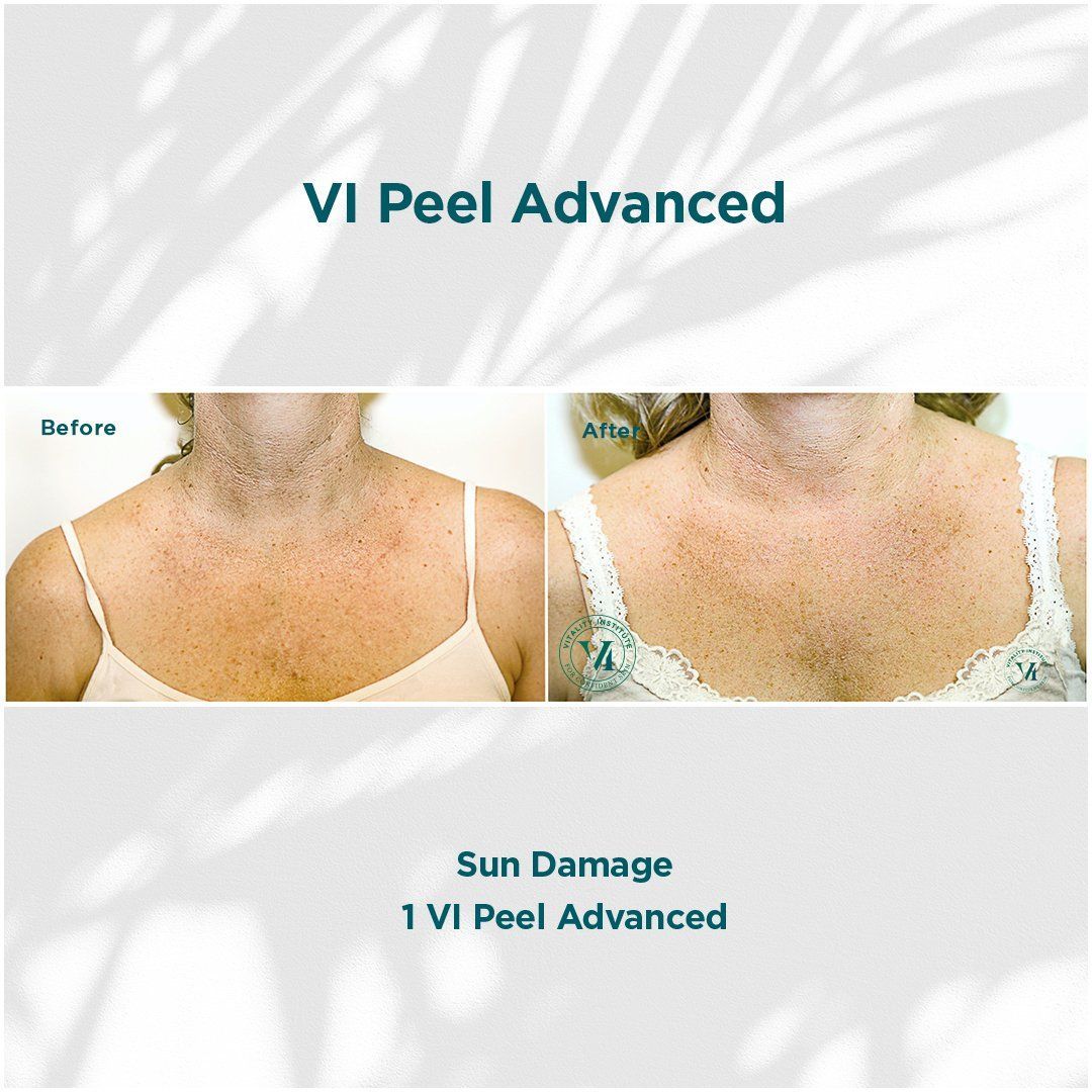 Before and after of sun damage on woman's neck after a VI Peel Advanced treatment.