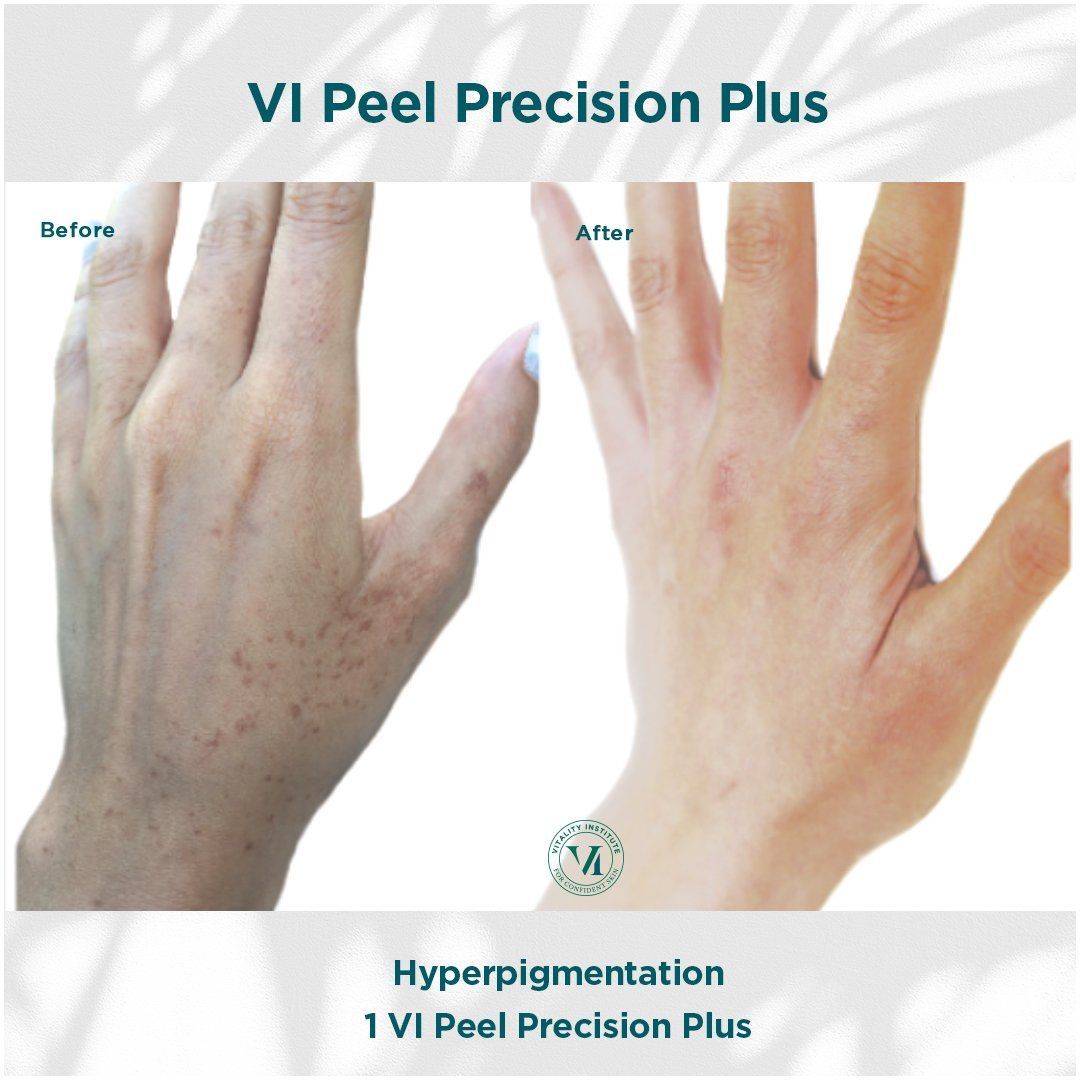 Hands before/after VI Peel Precision Plus. Before: hyperpigmentation. After: reduced hyperpigmentation.