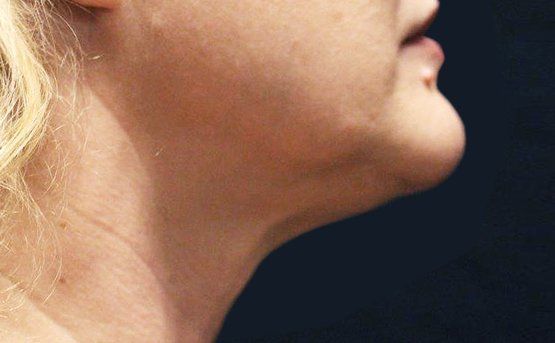 Profile view of a person's neck and jaw, showing a prominent double chin against a dark background.