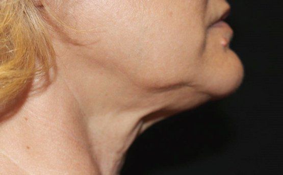 Profile view of a person's face and neck, showing skin with wrinkles and a visible double chin.