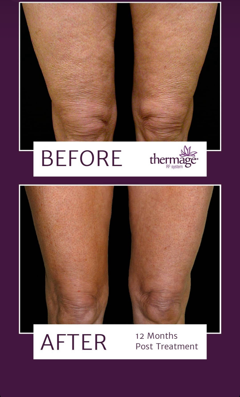 Thermage Bein Behandlung Vorher & Nachher