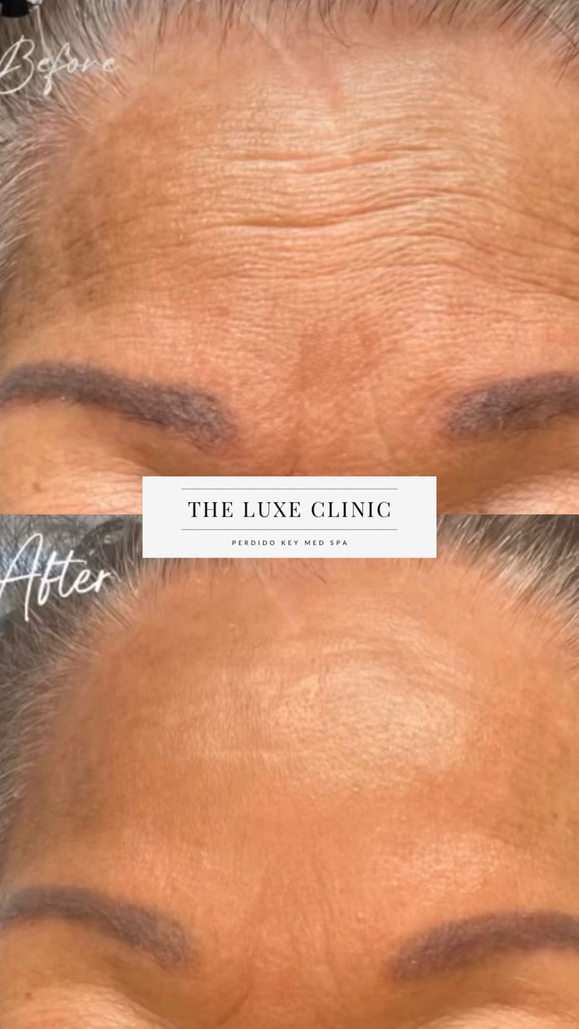 A before and after photo of a woman 's forehead.