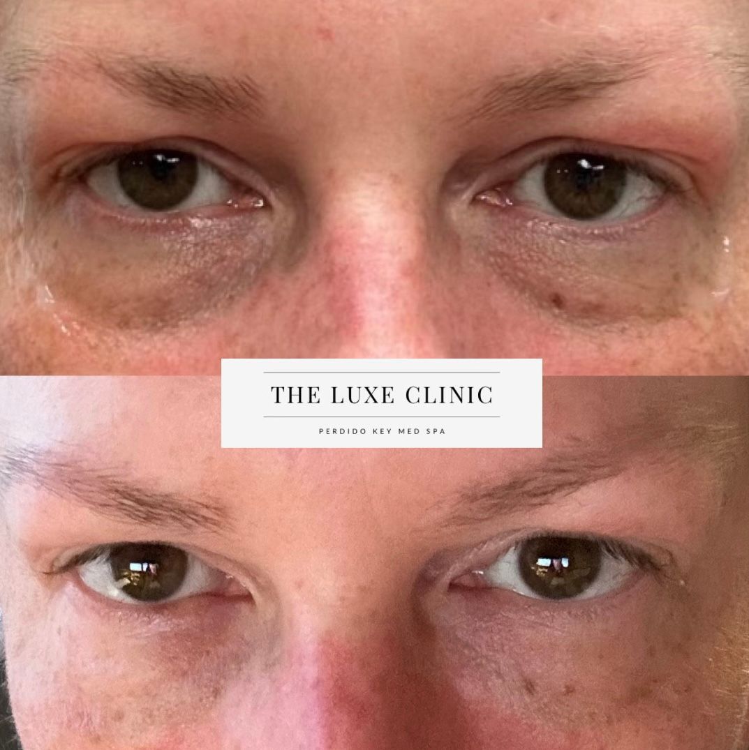 A before and after picture of a woman 's eyes.