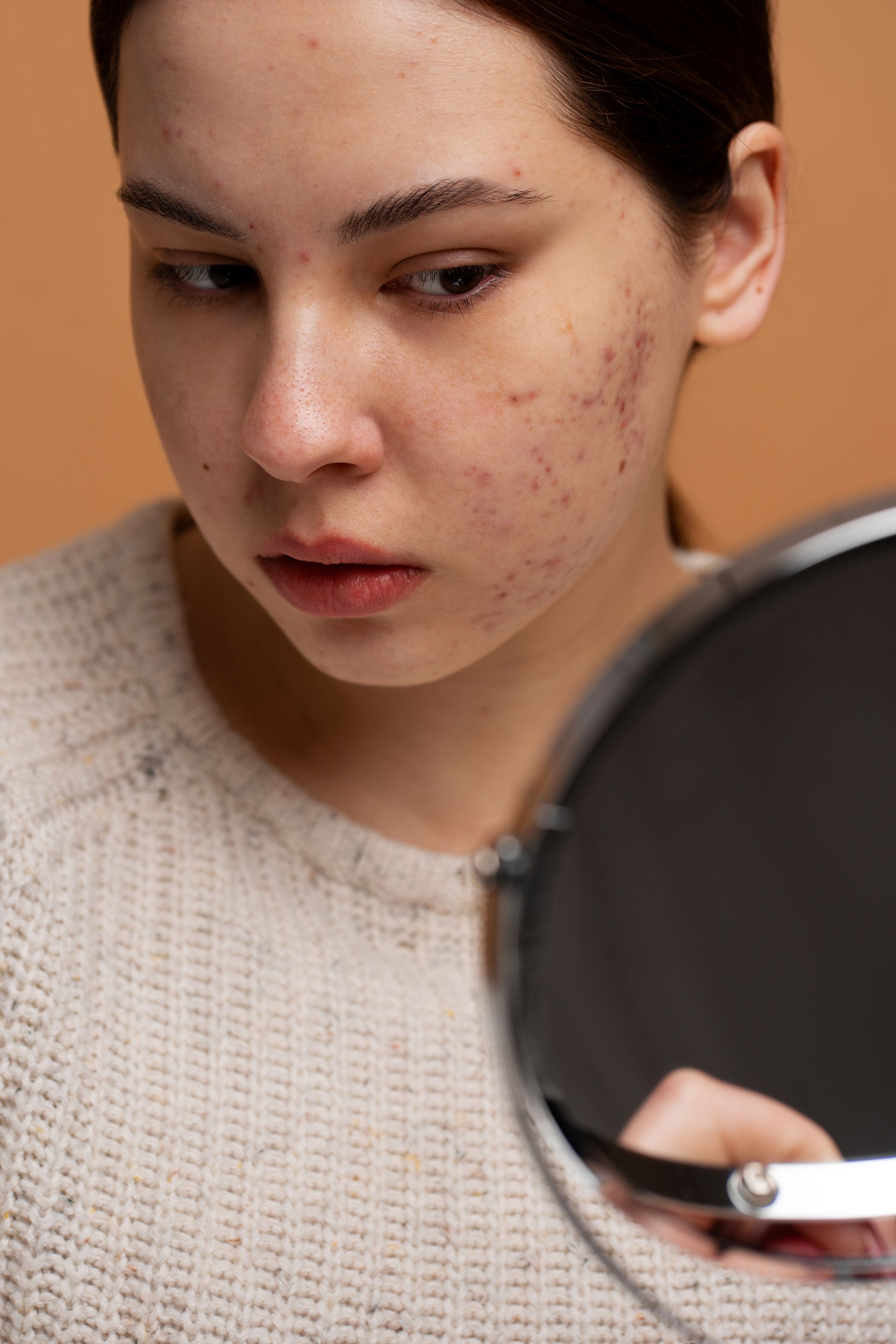 A woman with acne is looking at her face in a mirror.