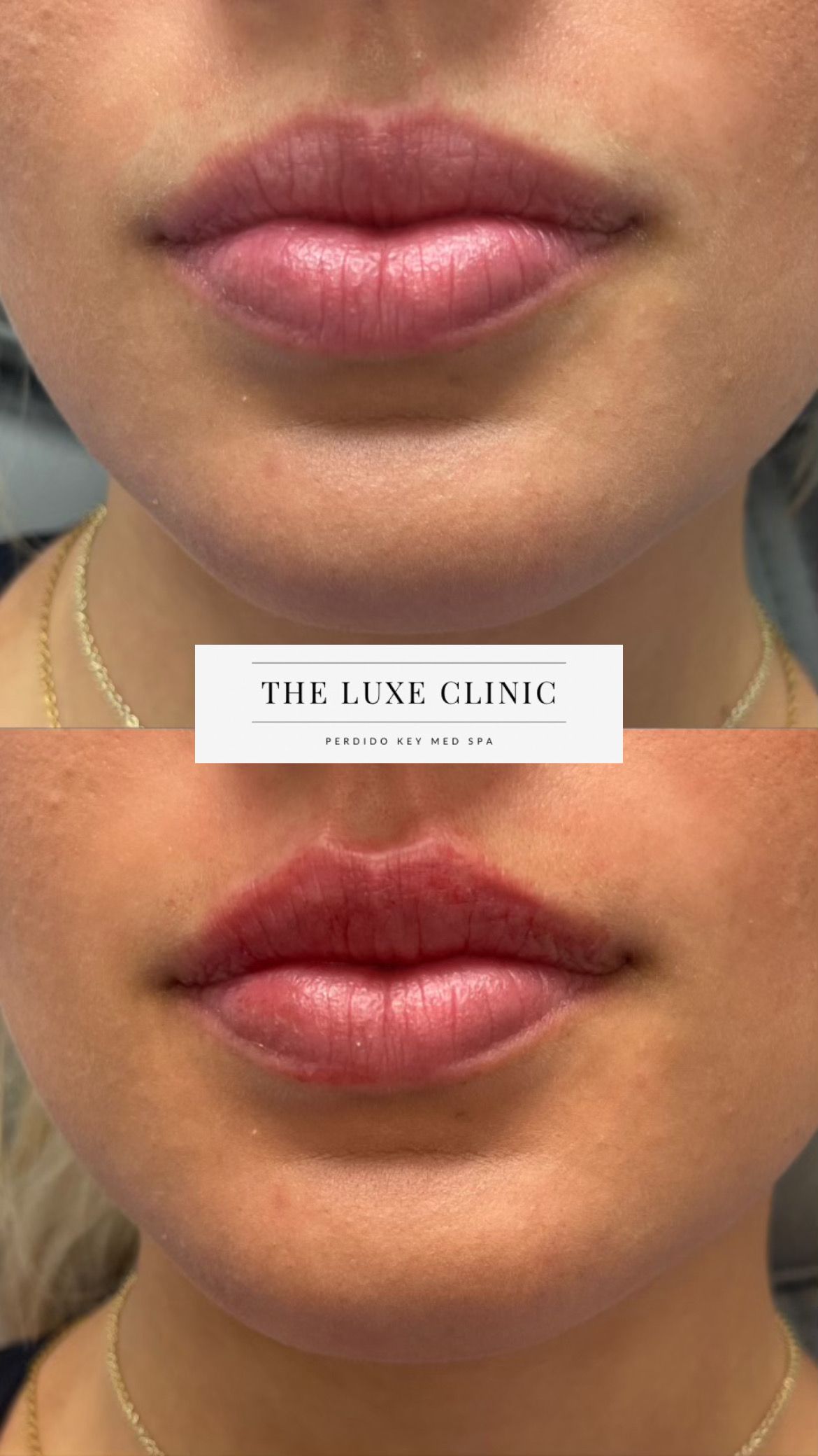 A before and after picture of a woman 's lips.