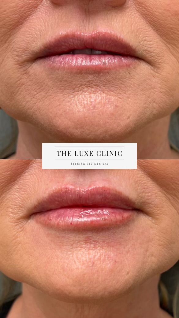 A before and after photo of a woman 's lips.
