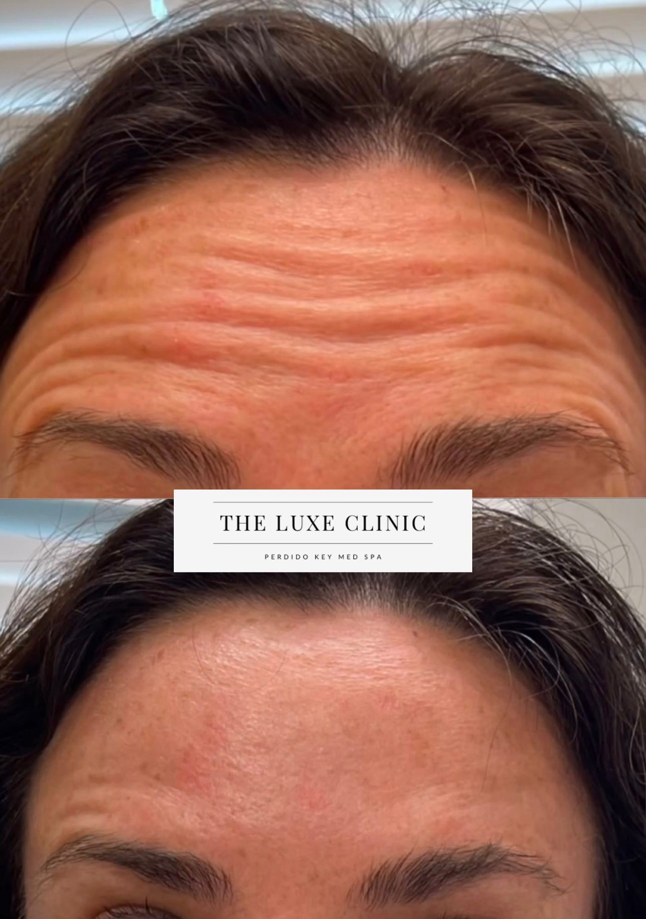 A before and after photo of a woman 's forehead with wrinkles.