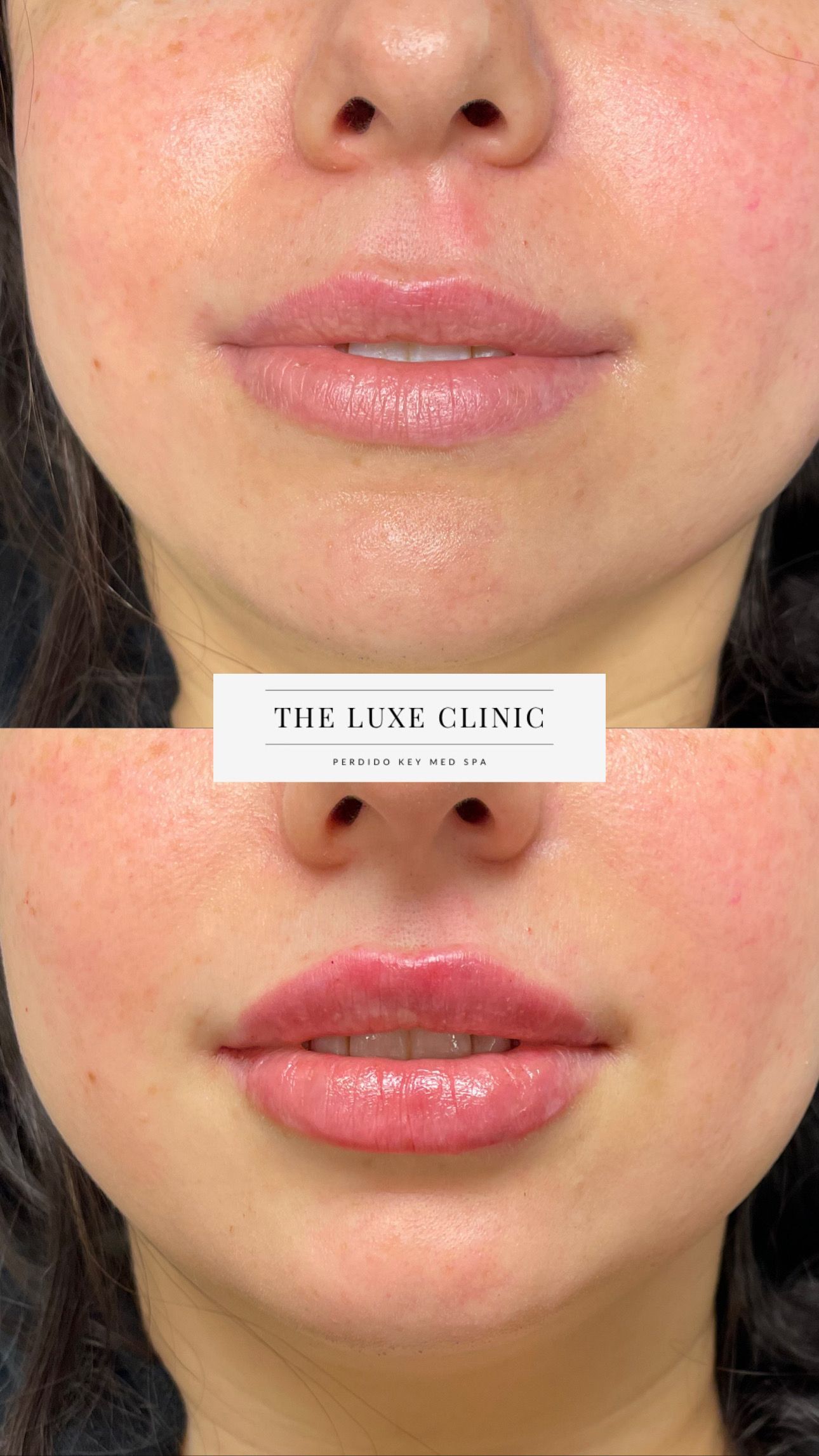 A before and after photo of a woman 's lips.