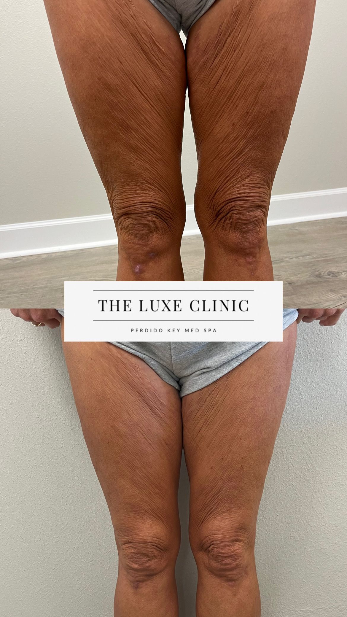 A woman 's legs are shown before and after surgery.