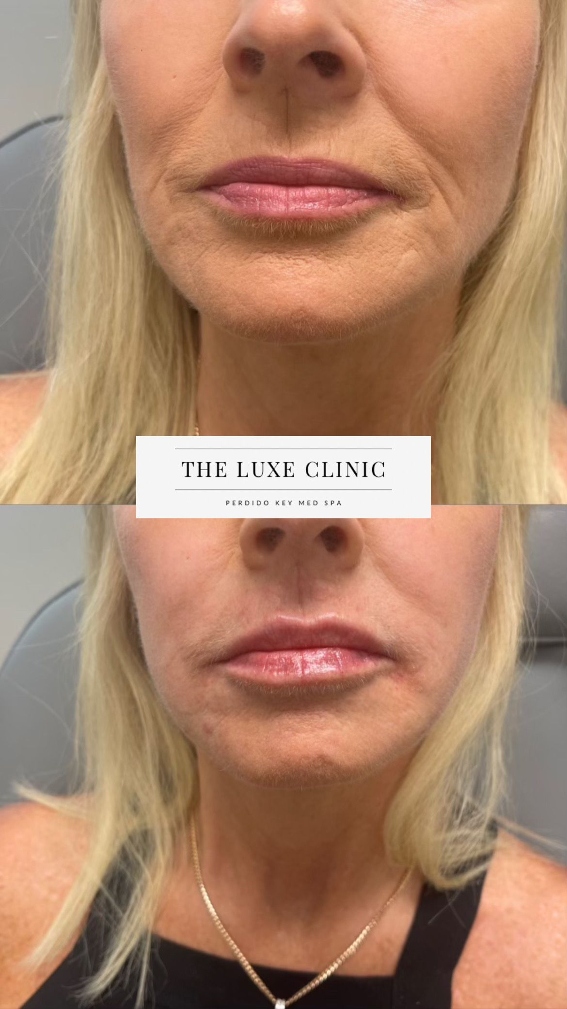 A before and after photo of a woman 's lips.