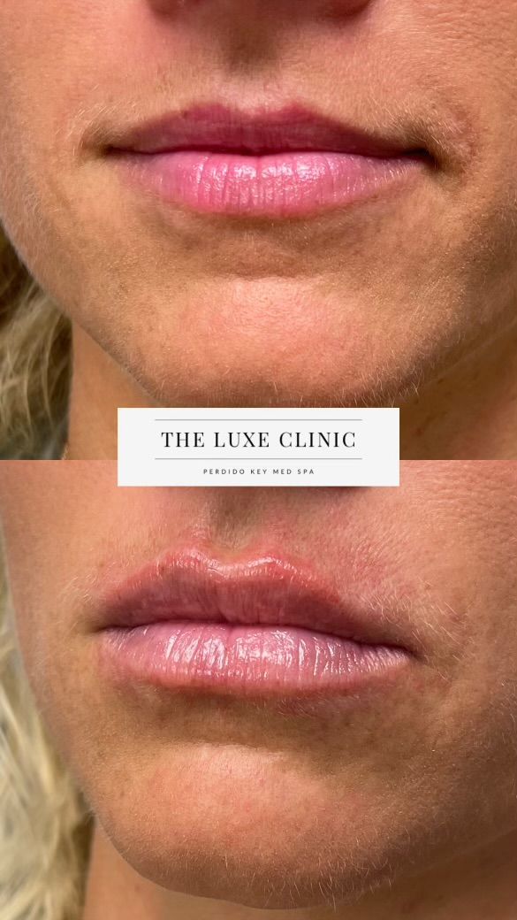 A before and after photo of a woman 's lips.
