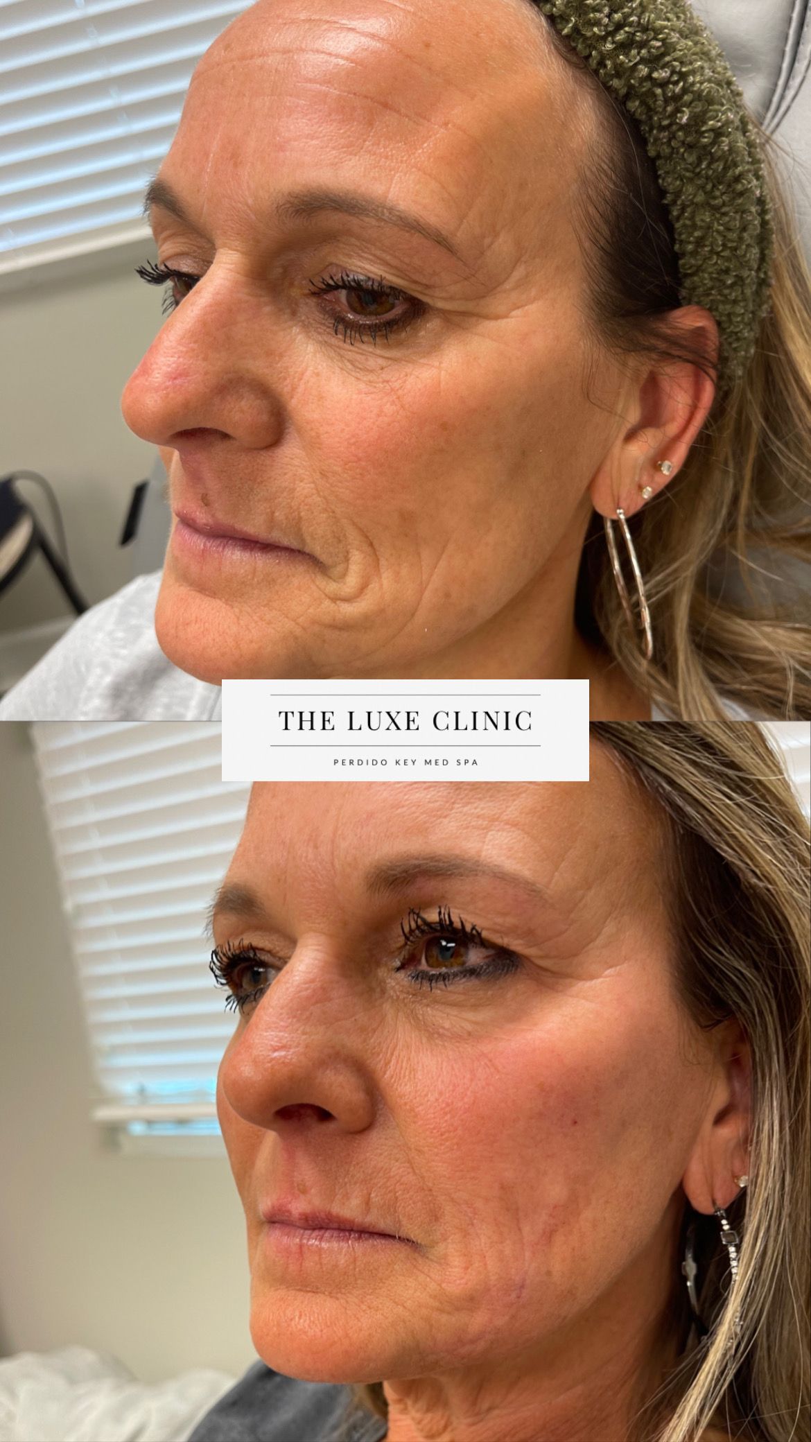 A before and after photo of a woman 's face.