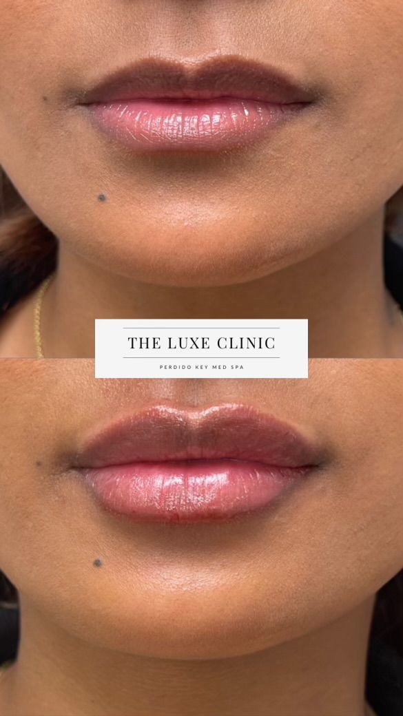 A before and after photo of a woman 's lips.