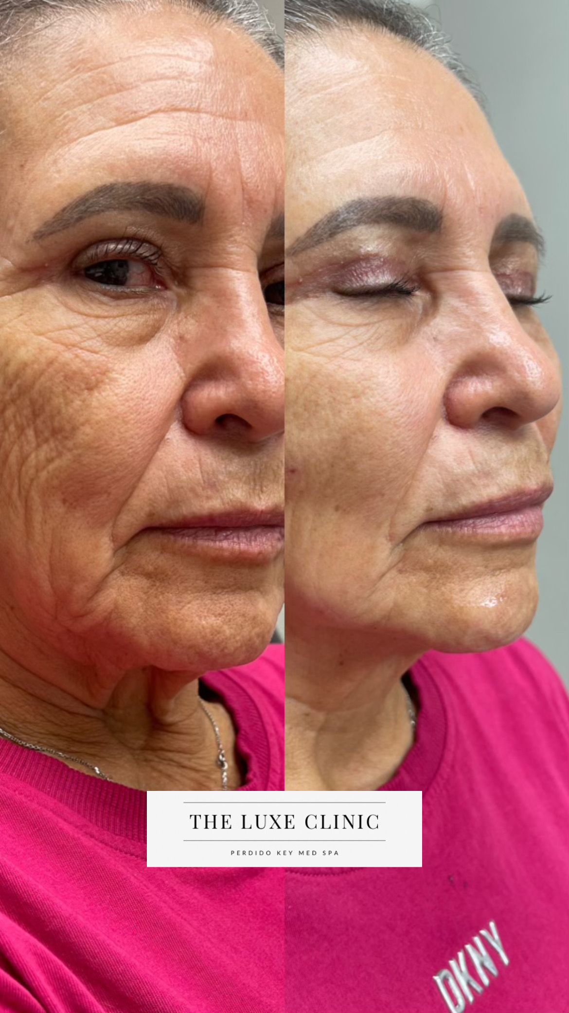 A before and after photo of a woman 's face.
