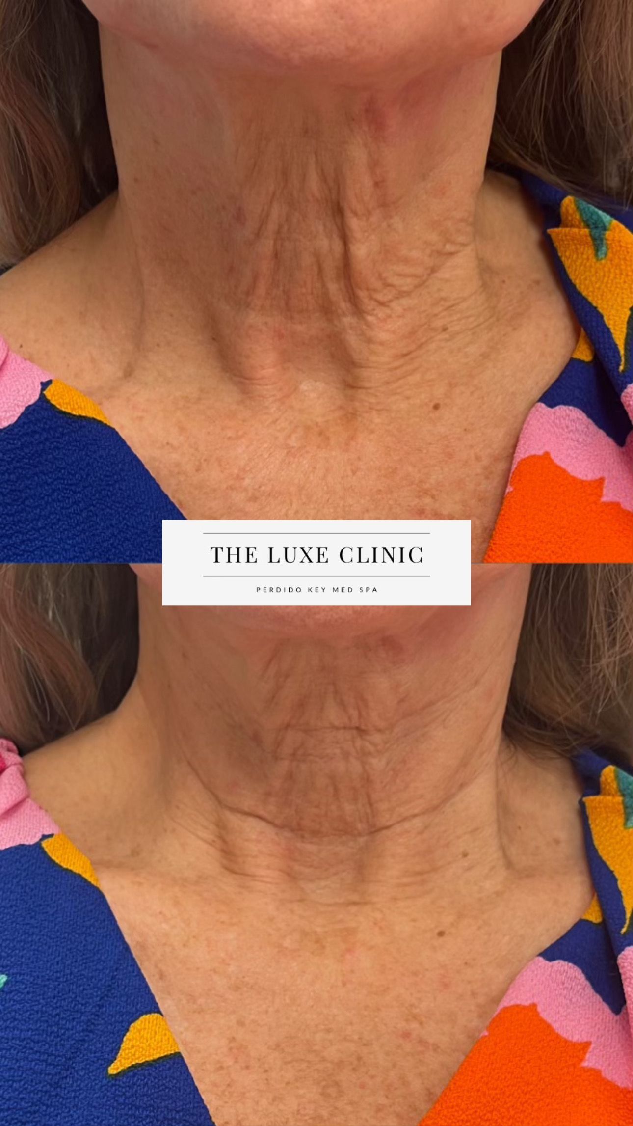 A woman 's neck is shown before and after a treatment.