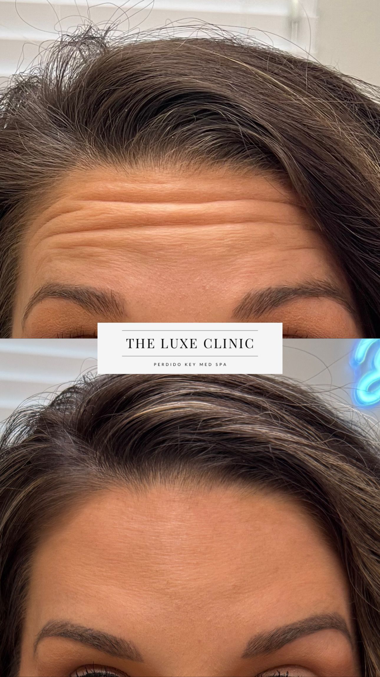 A woman 's forehead before and after botox injections.