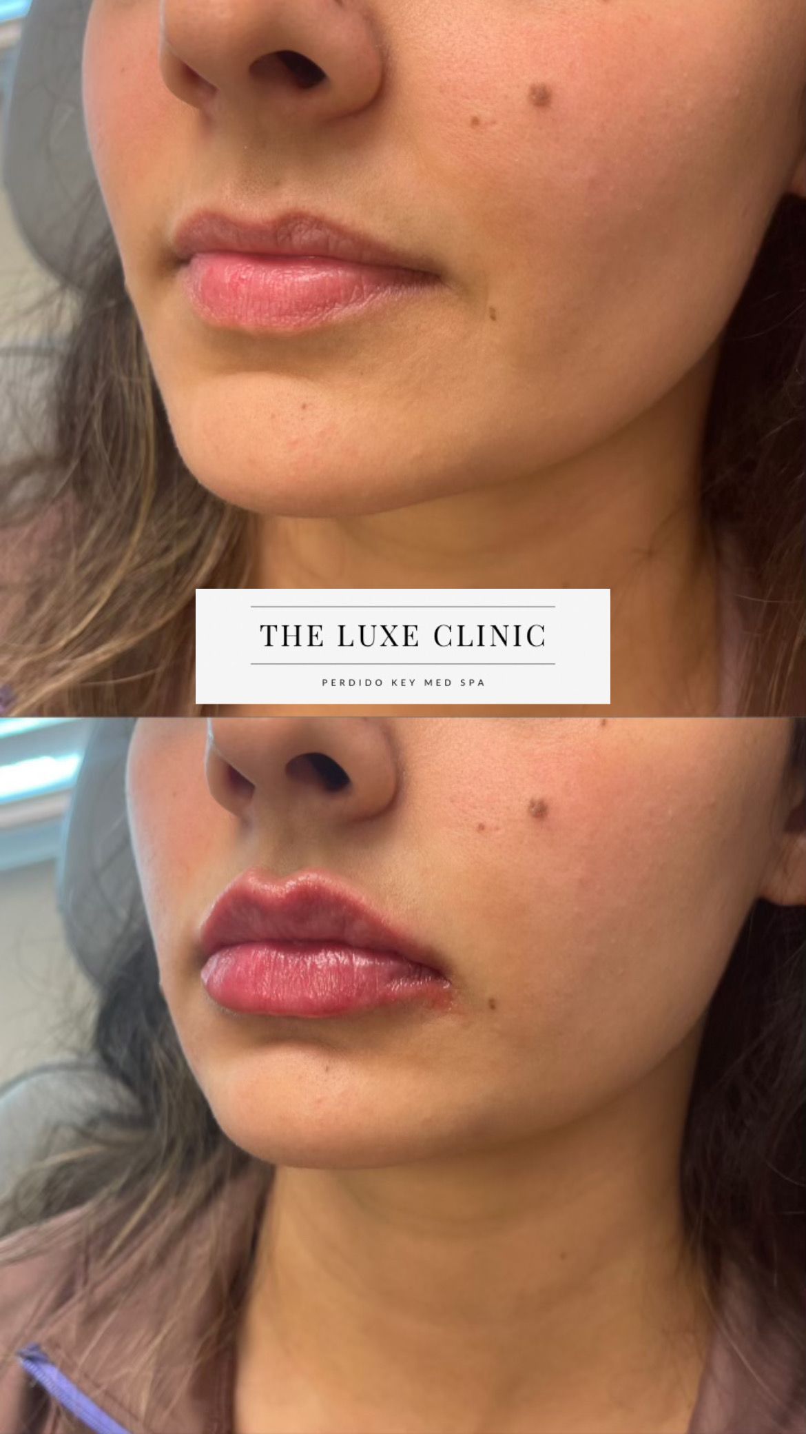 A before and after photo of a woman 's lips.