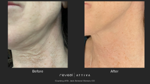 A before and after photo of a woman's neck and face