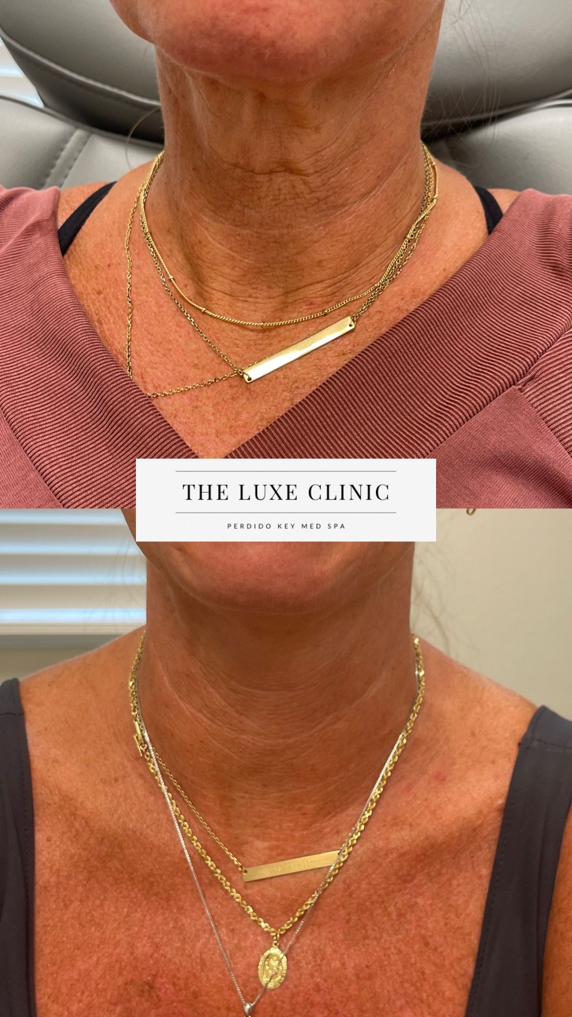 A before and after photo of a woman 's neck and neckline.
