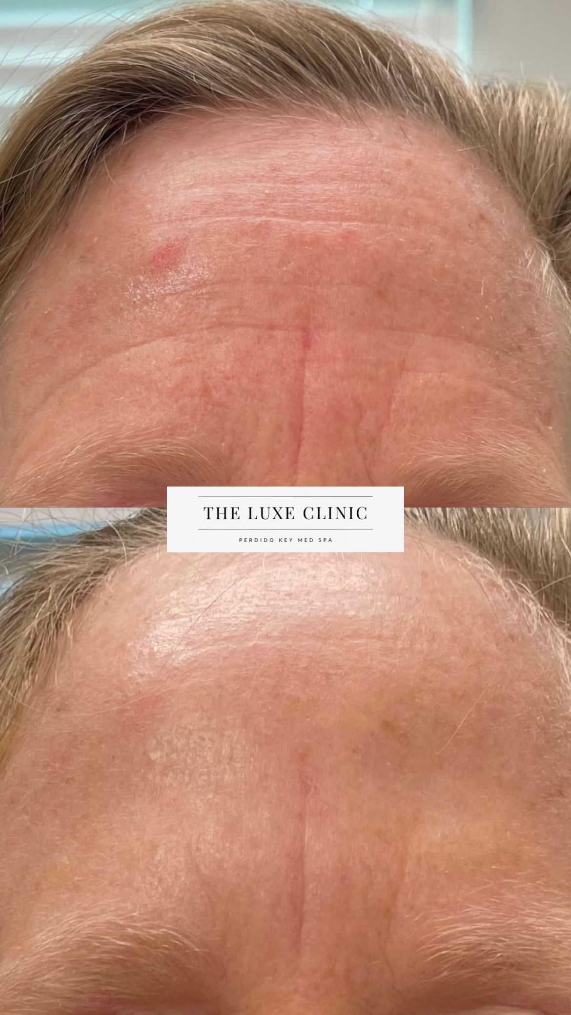 A before and after photo of a woman 's forehead.