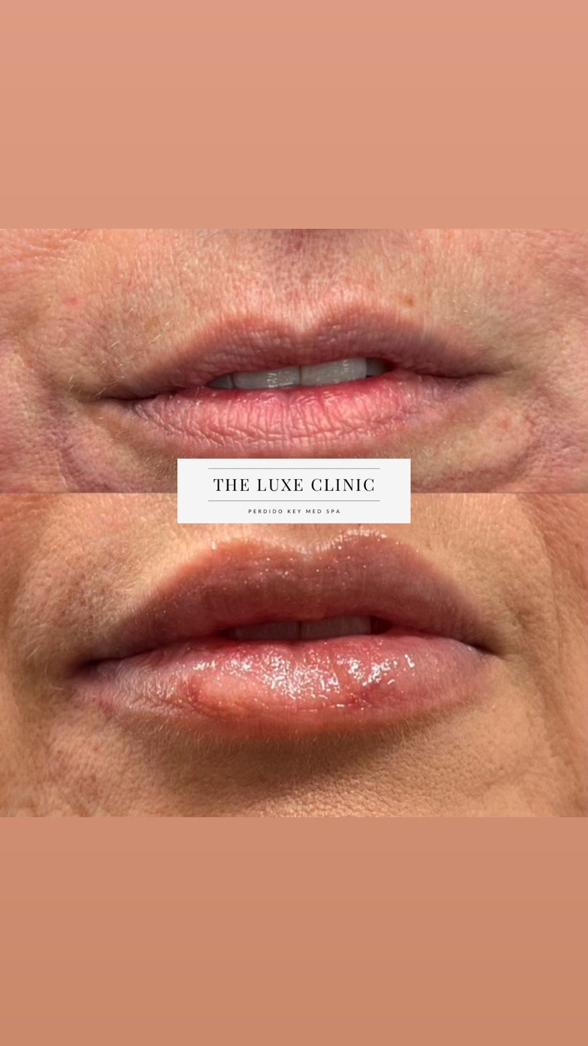 A before and after photo of a woman 's lips.