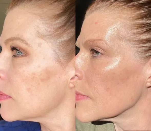 A before and after photo of a woman 's face.