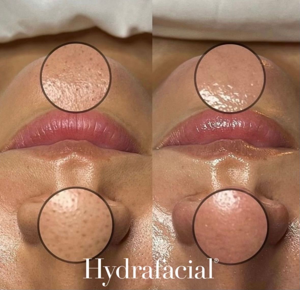 A woman 's face before and after a hydrafacial treatment