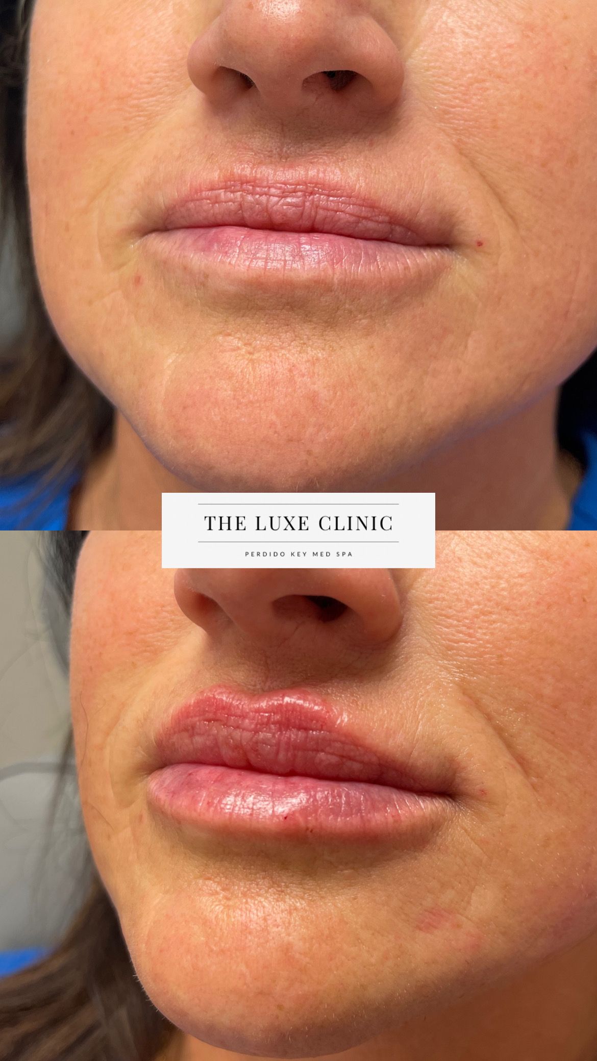 A before and after photo of a woman 's lips.