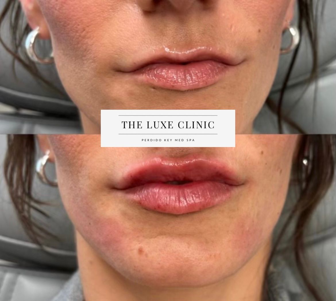 A before and after photo of a woman 's lips from the luxe clinic