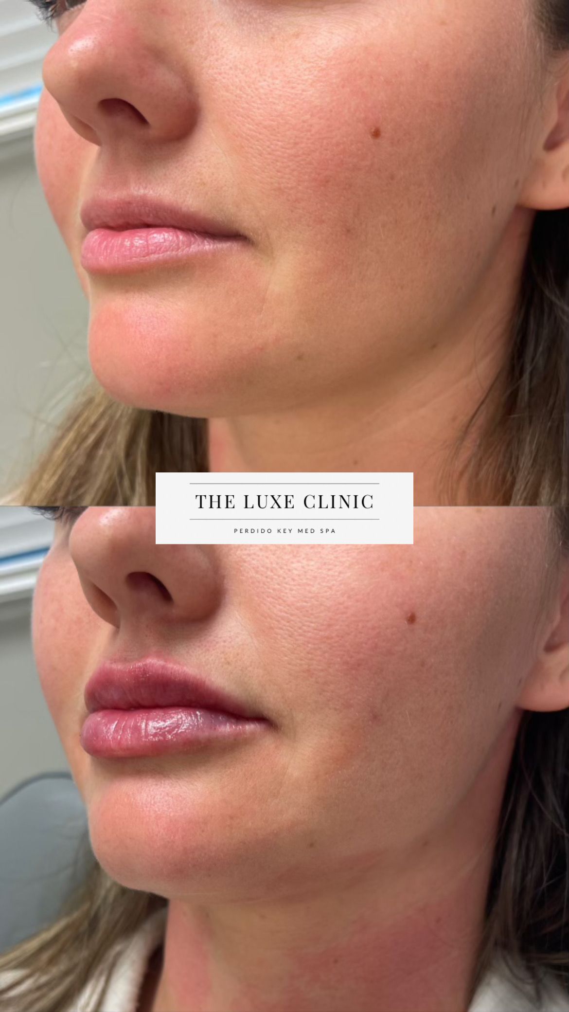 A before and after photo of a woman 's lips.