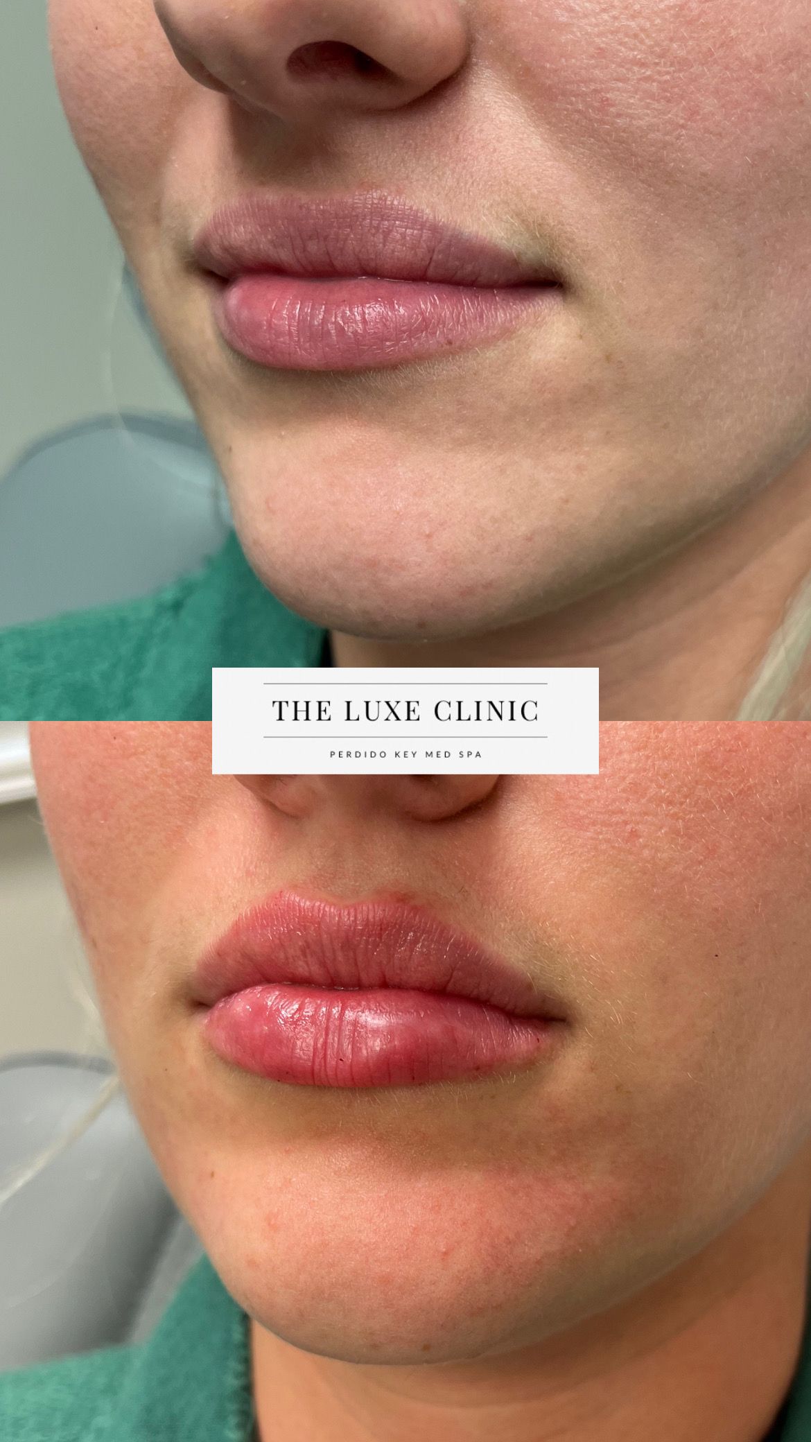 A before and after photo of a woman 's lips.