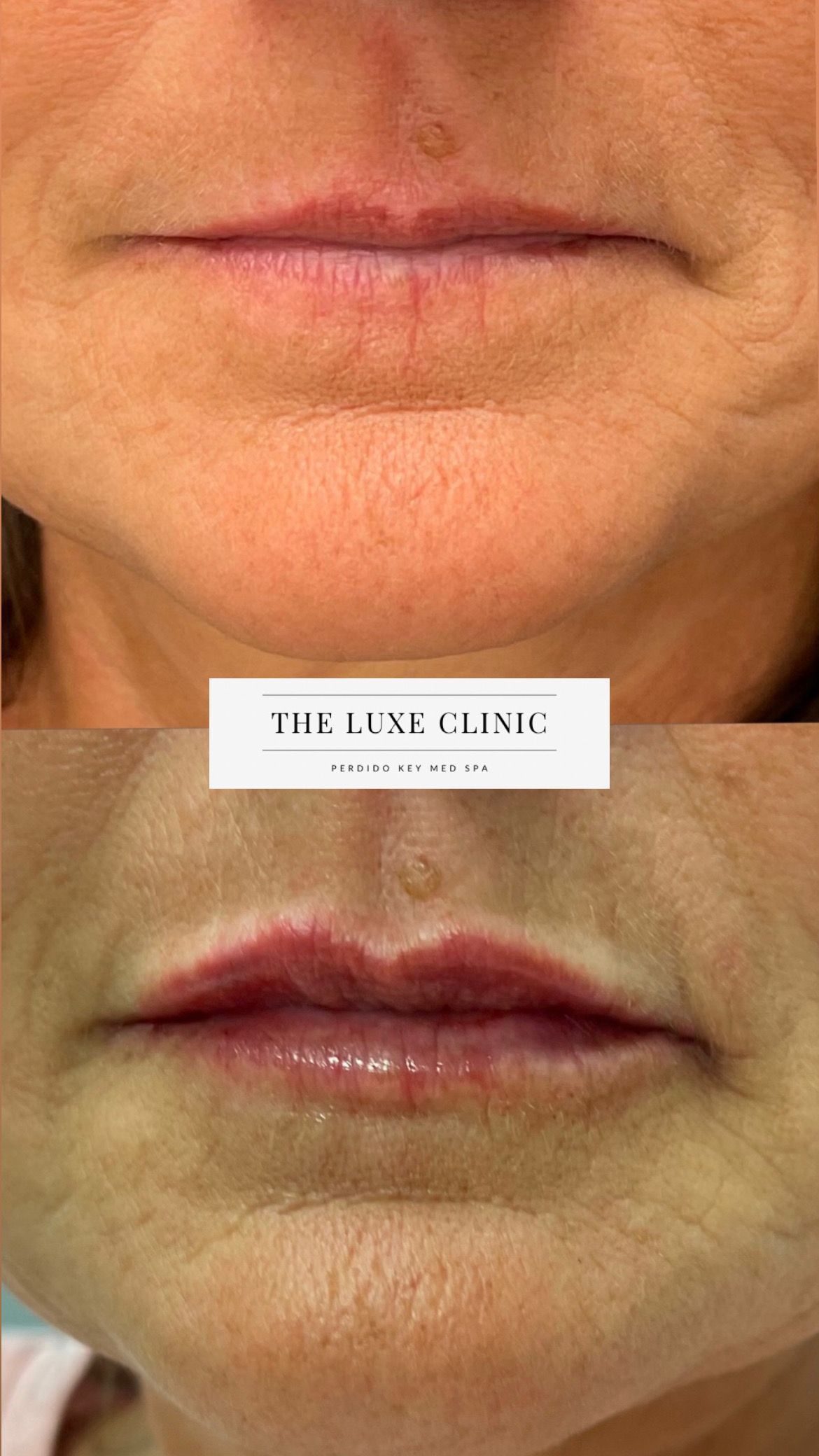 A before and after photo of a woman 's lips.