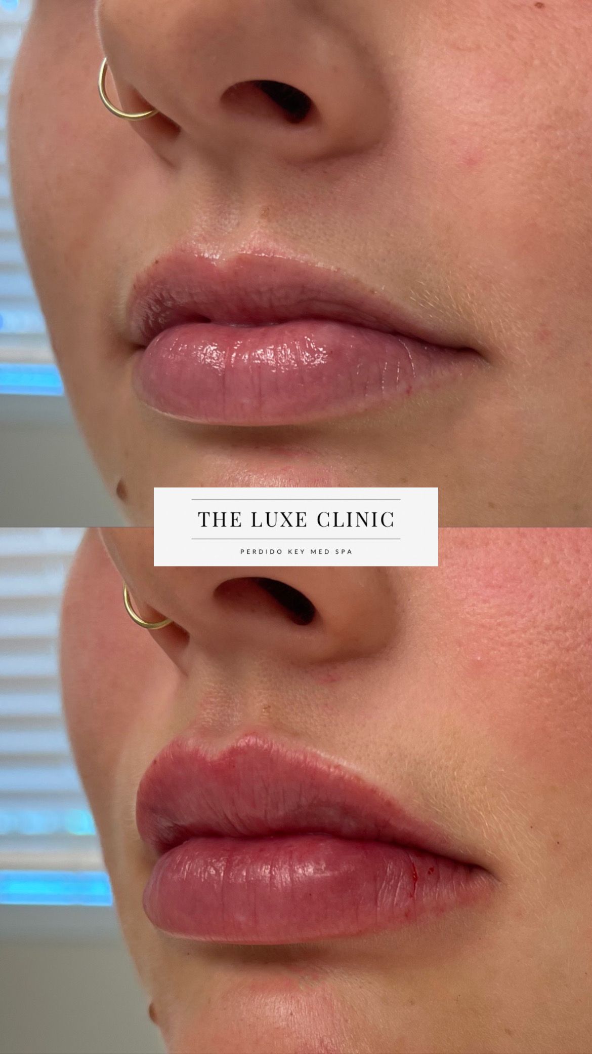A before and after photo of a woman 's lips.