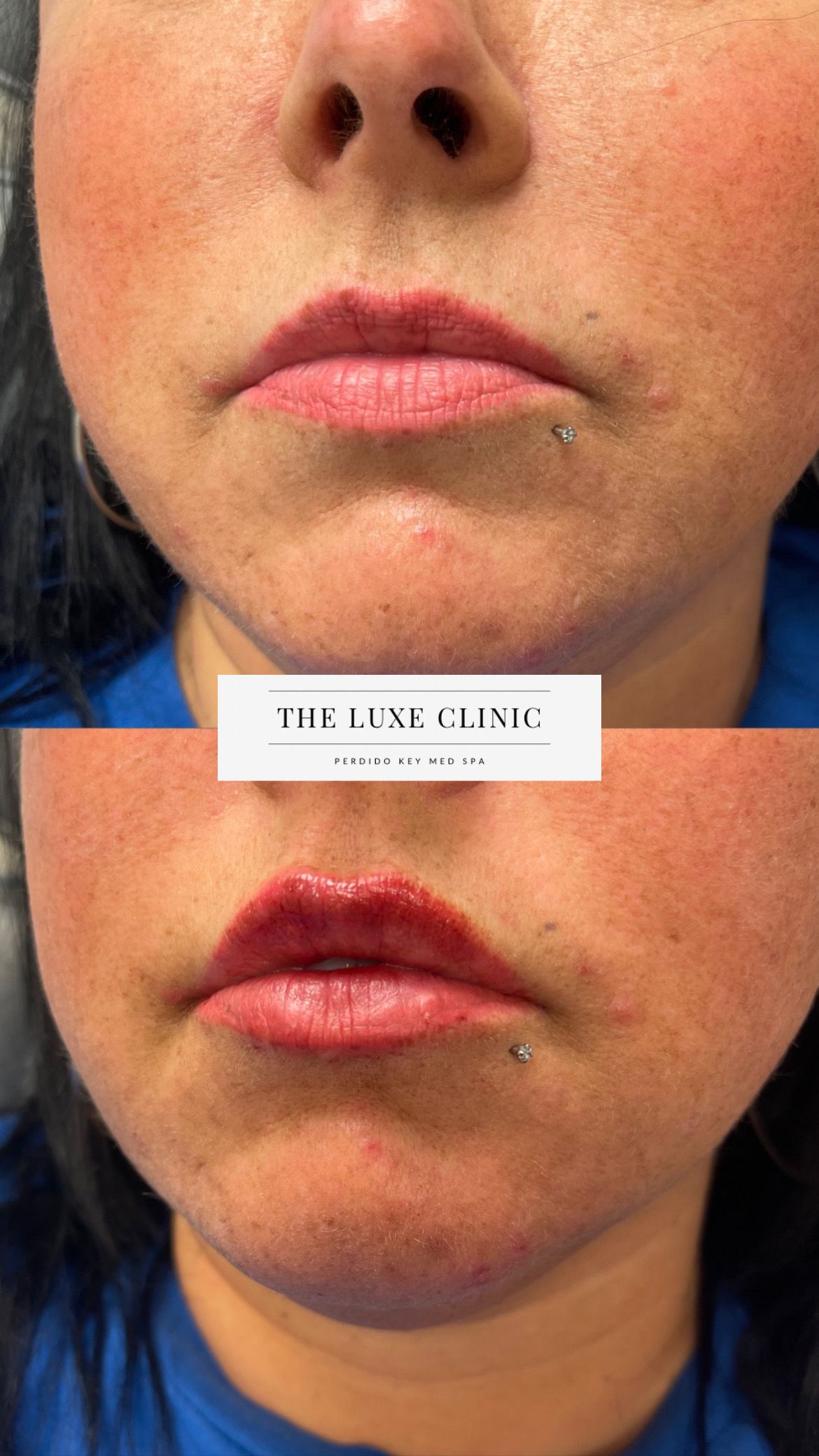 A before and after photo of a woman 's lips.