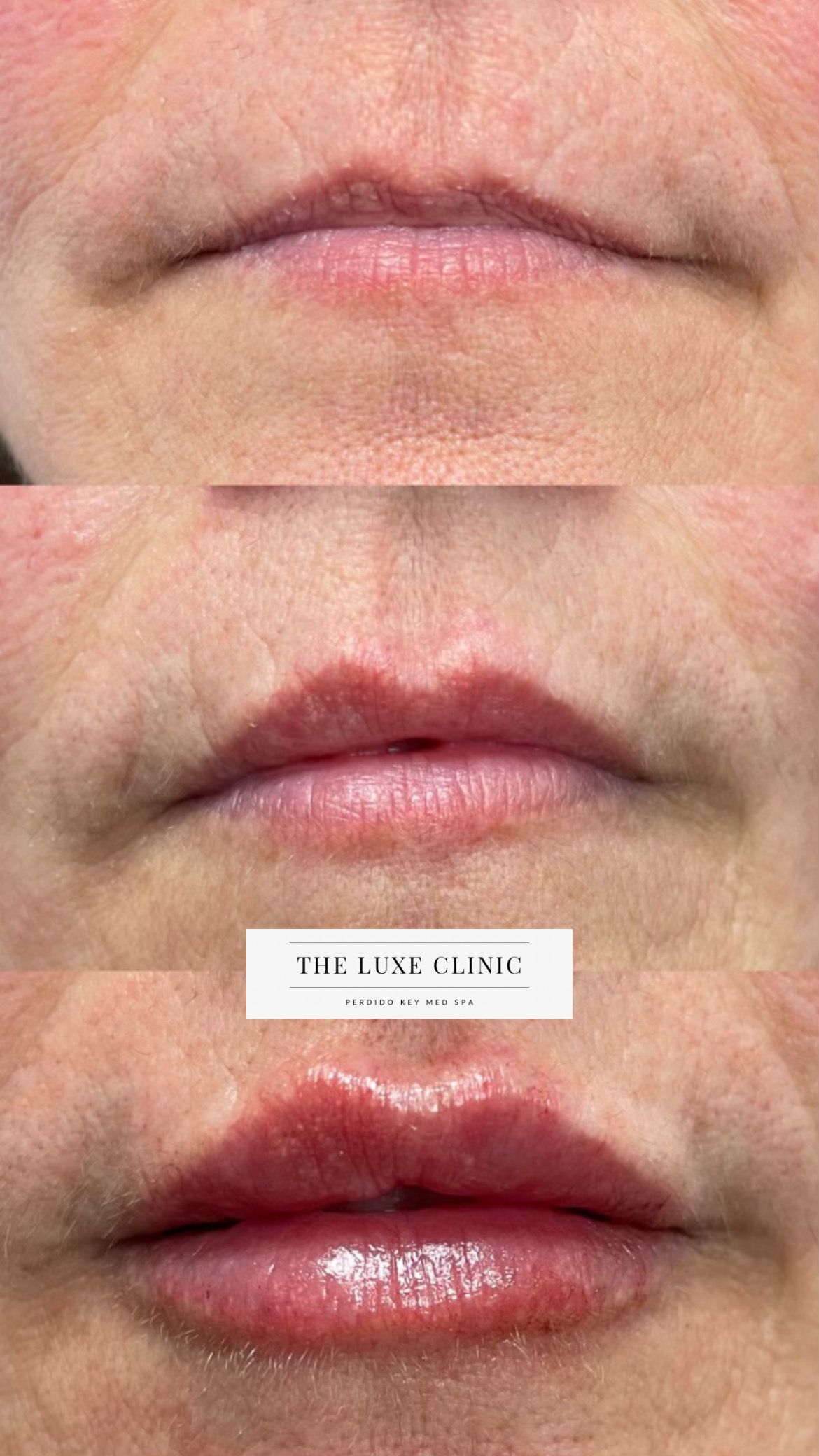 A before and after photo of a woman 's lips.