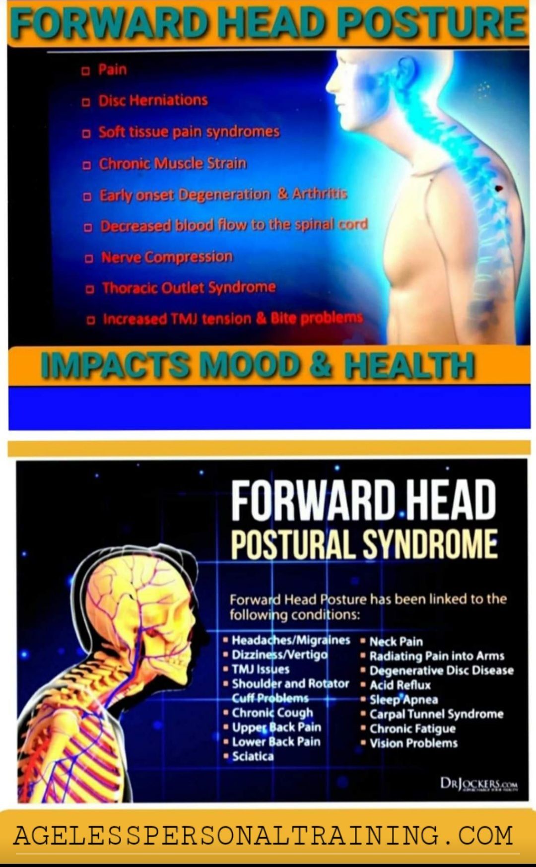 A poster about forward head posture and forward head postural syndrome