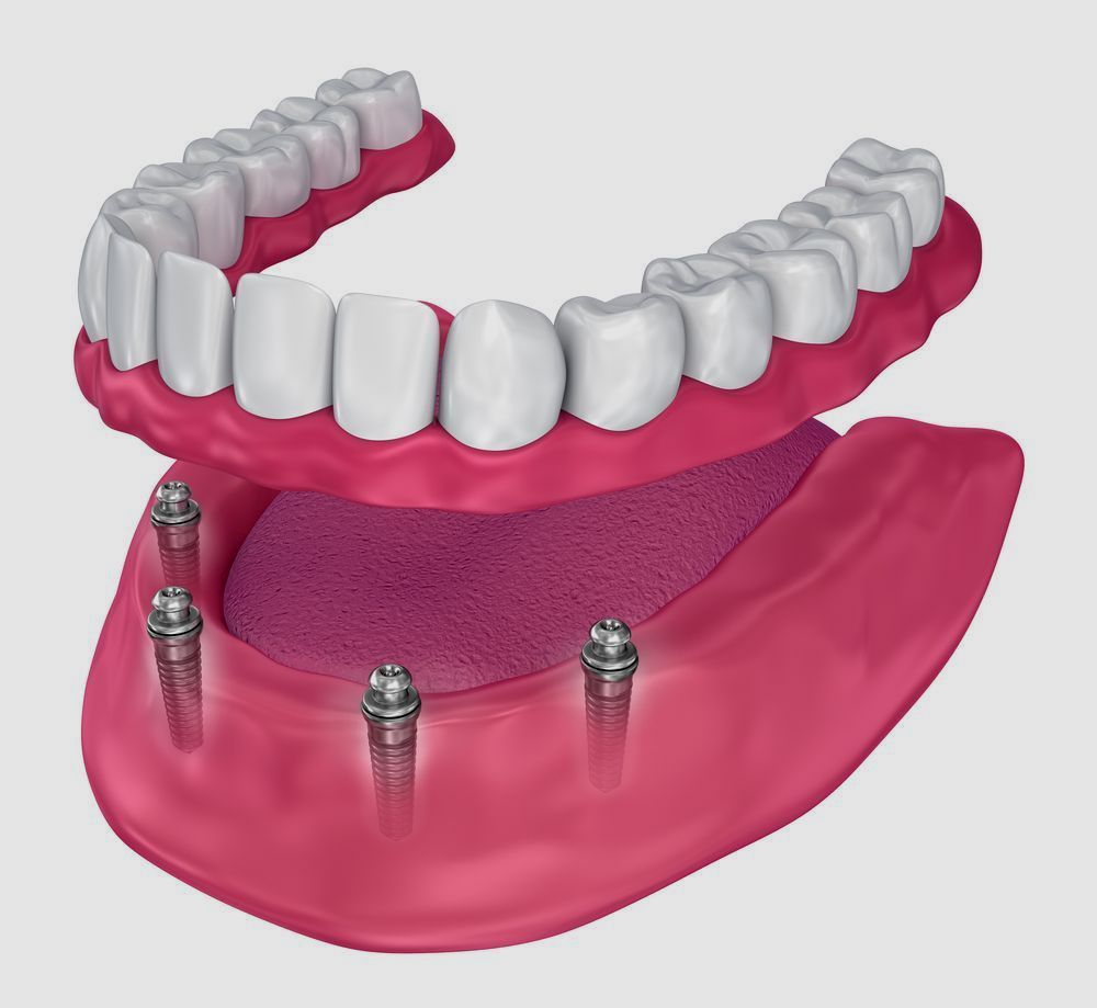 An illustration of a full denture with screws in it