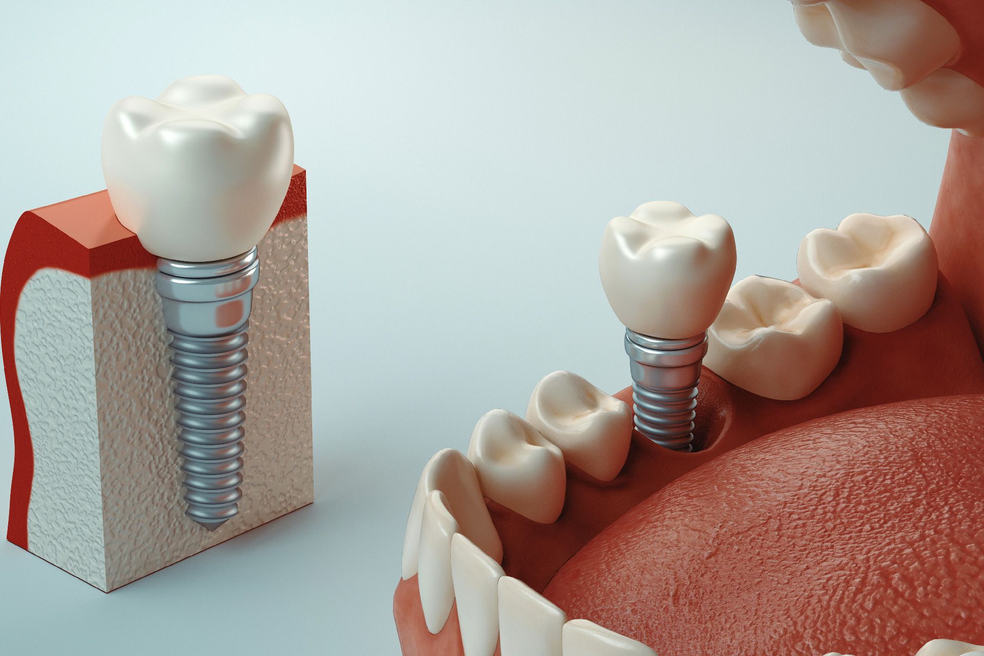Diagrama de implantes dentales: se muestra un diente sobre un implante junto a la mandíbula humana con implantes instalados.