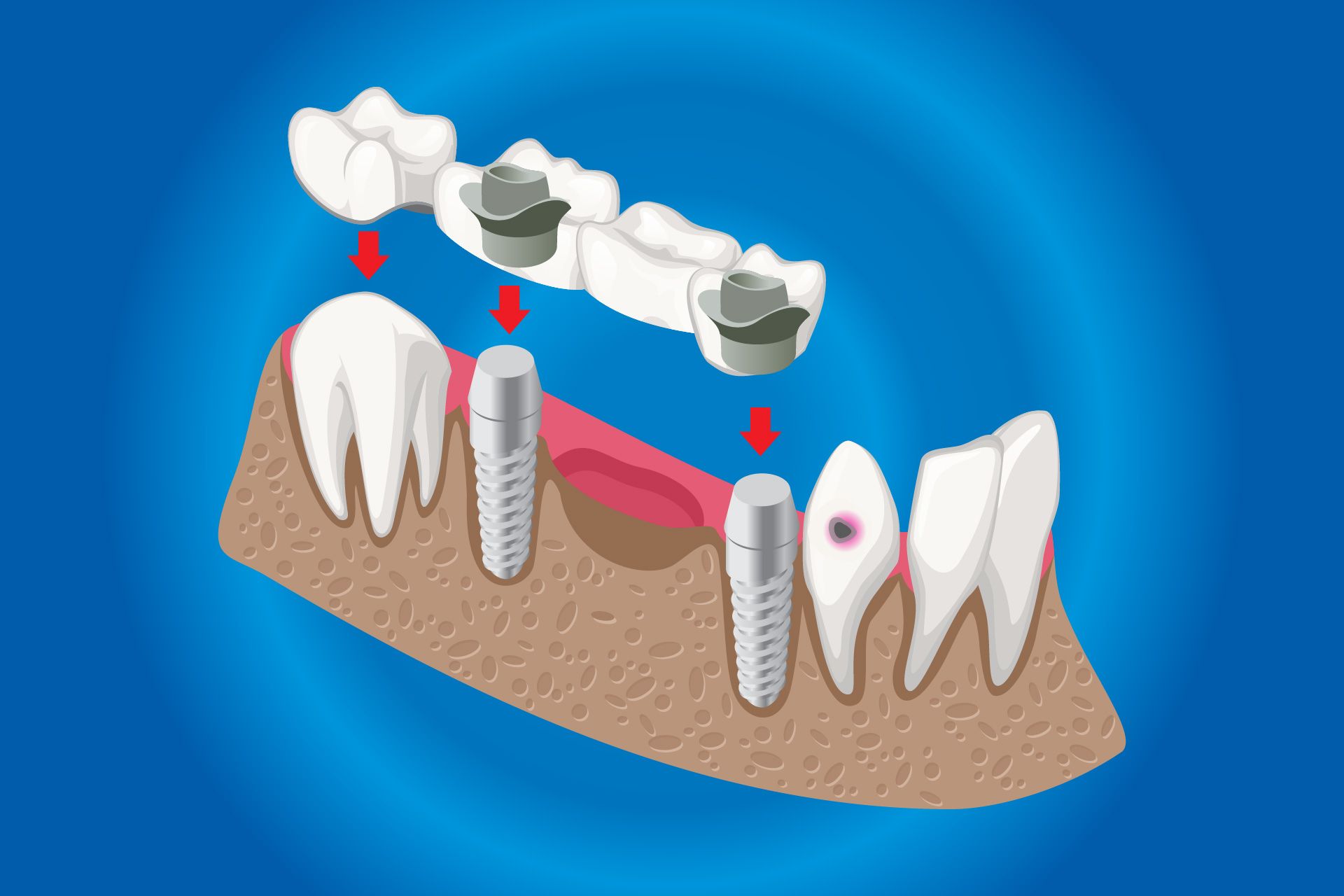 Puente dental con dientes artificiales que se colocan sobre implantes en la mandíbula.