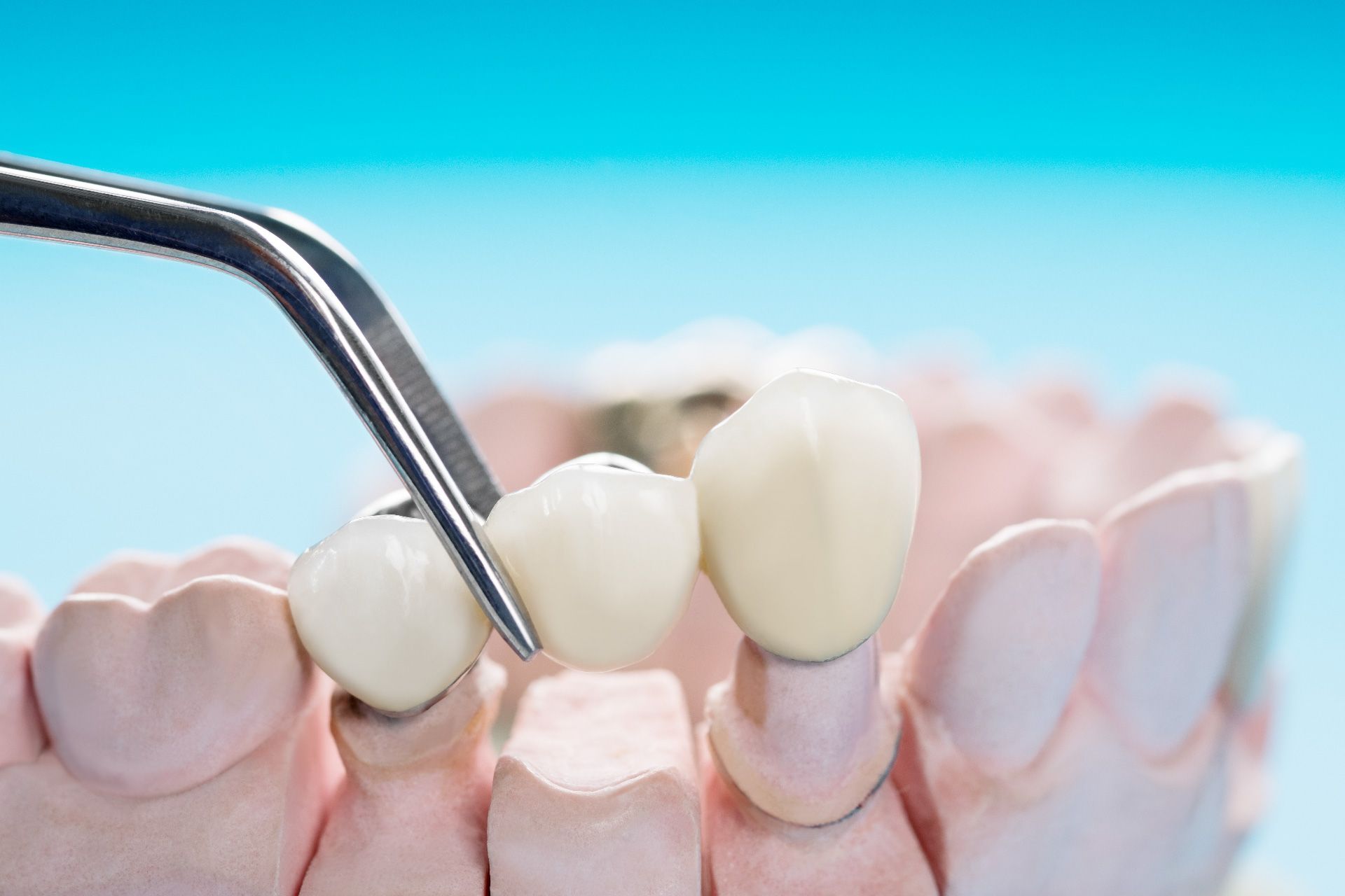 Puente dental siendo colocado sobre modelo de dientes con pinzas, fondo azul.