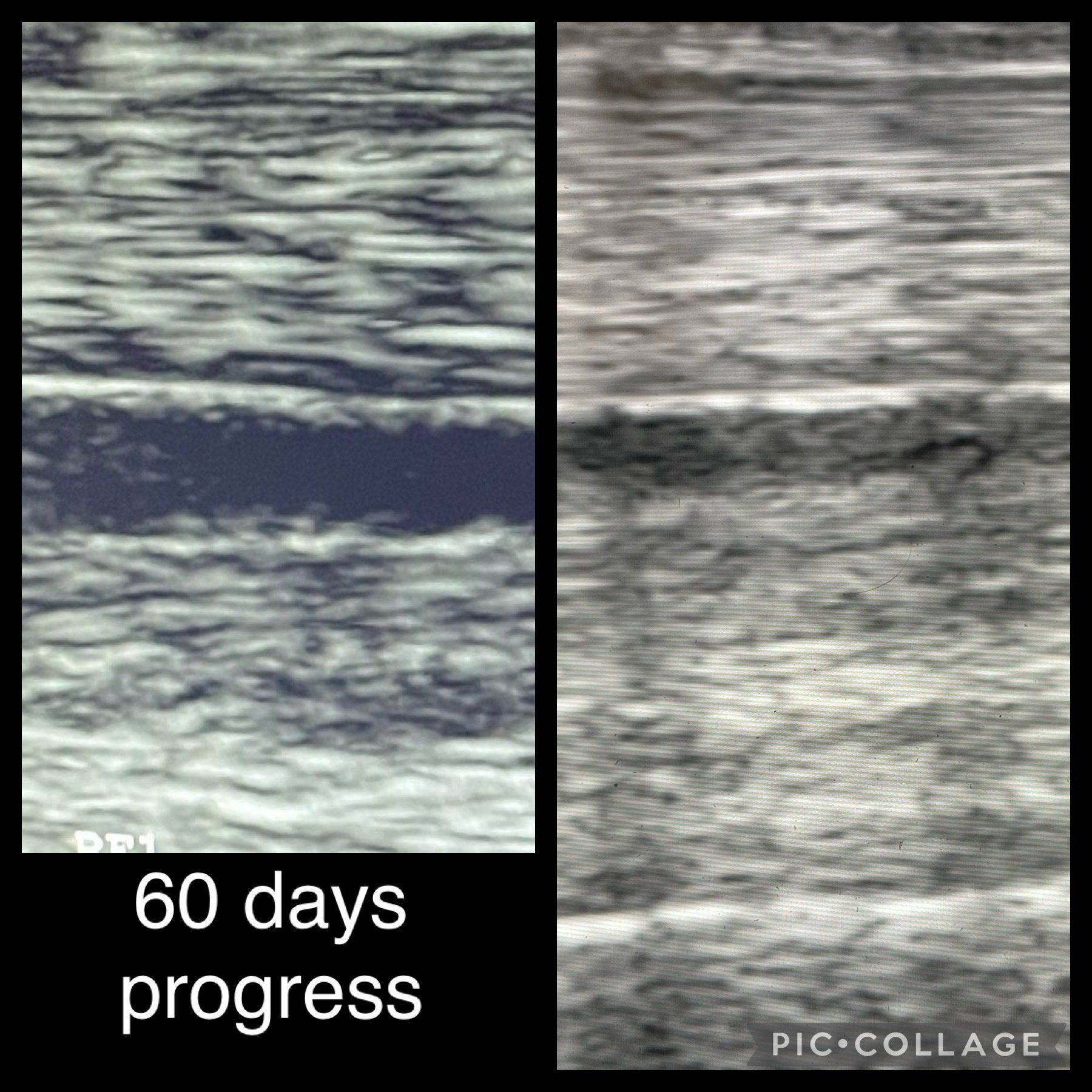 A collage of two ultrasound images showing 60 days progress