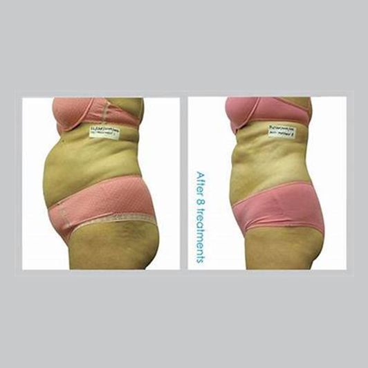 Before and After I-Lipo Treatment — Antioch, IL — Sleepwatchers LLC