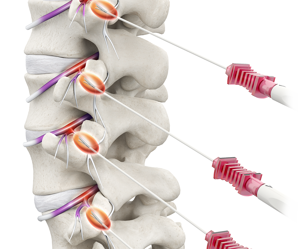 Medical illustration: Needles injecting medication into the spine, showing the bones, discs, and nerves.