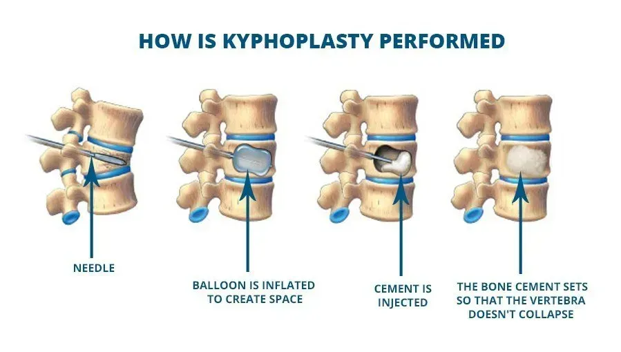 Diagram of kyphoplasty procedure: needle insertion, balloon inflation, cement injection, and cement setting in the vertebra.