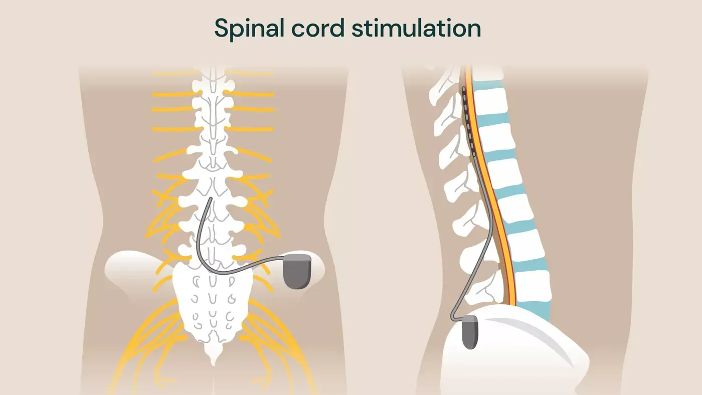 Illustration of spinal cord stimulation device implanted in the back, showing leads and a pulse generator.
