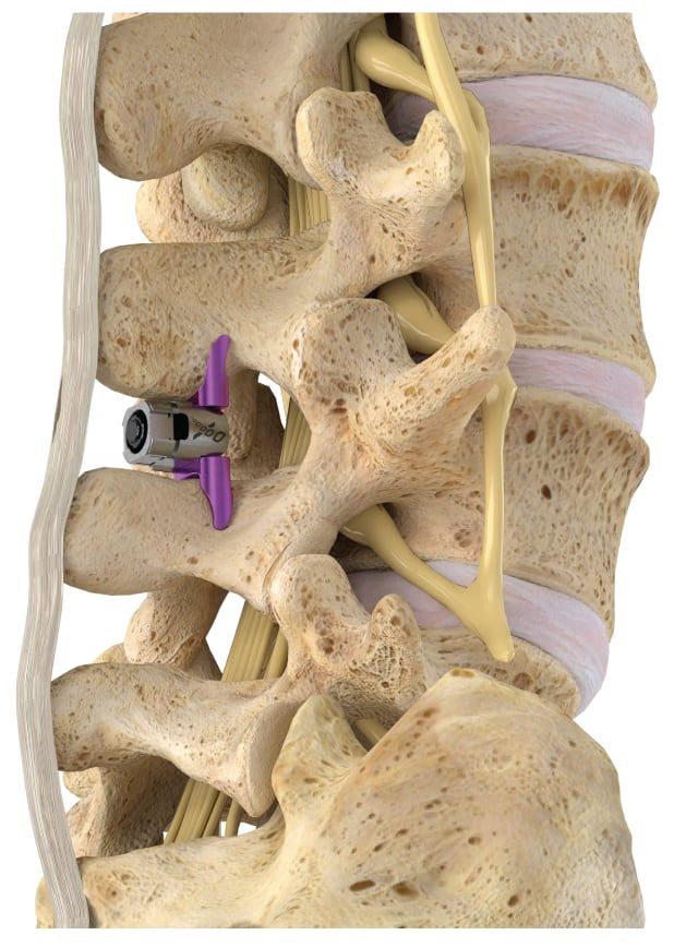 Illustration of lumbar spine with implanted spinal fusion device in the vertebral body.
