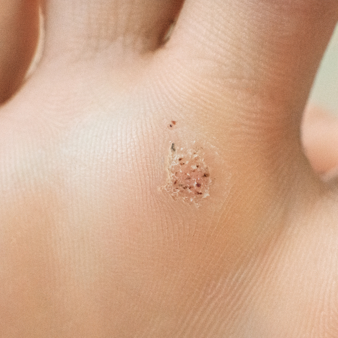 Picture of a verruca infection growing on the skin of a foot. 